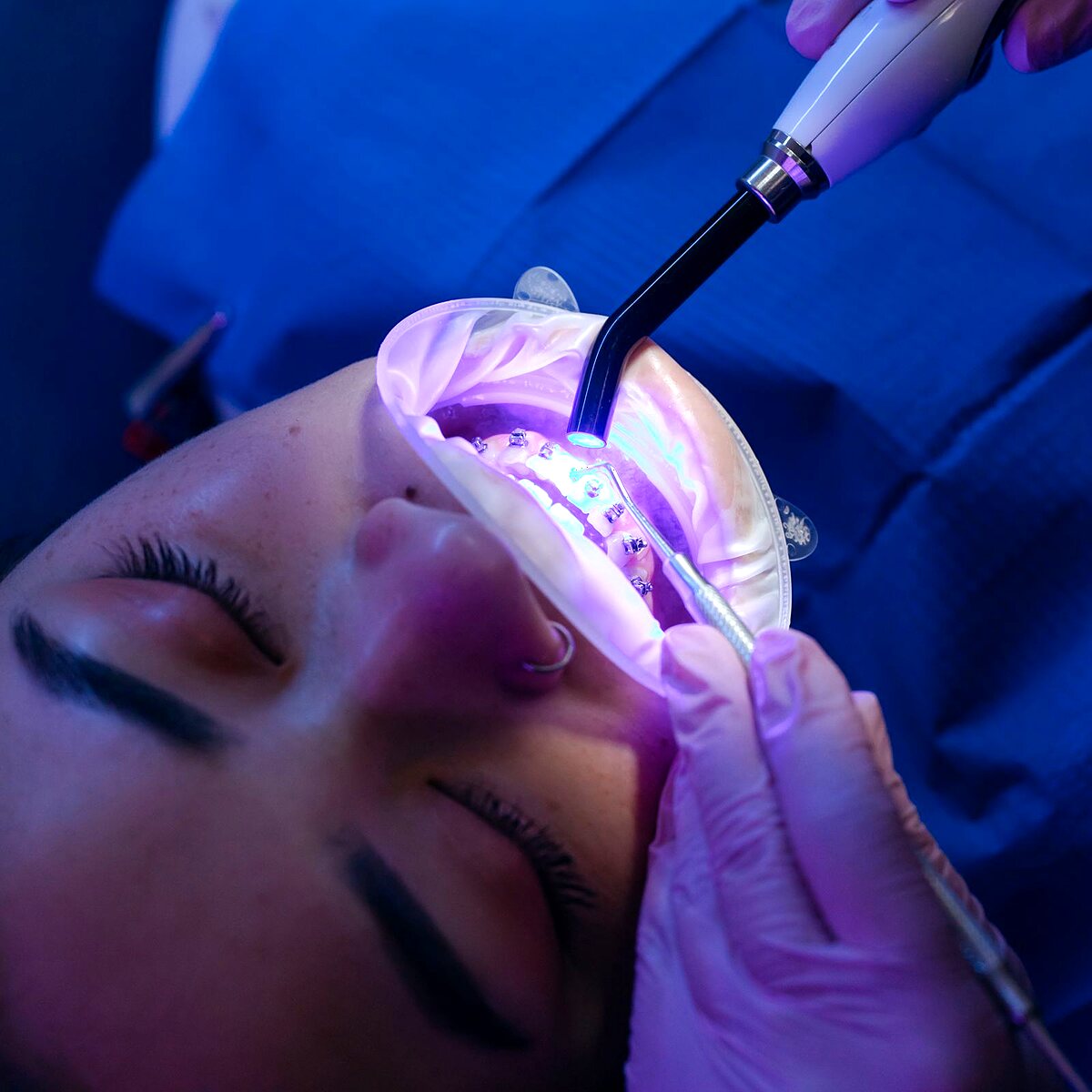 Blanqueamiento Dental en Dental Spekter Cuernavaca