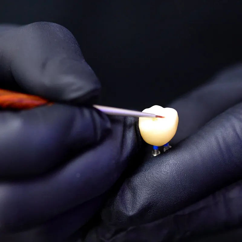 Carilla de cerámica caracterizada a mano en el laboratorio