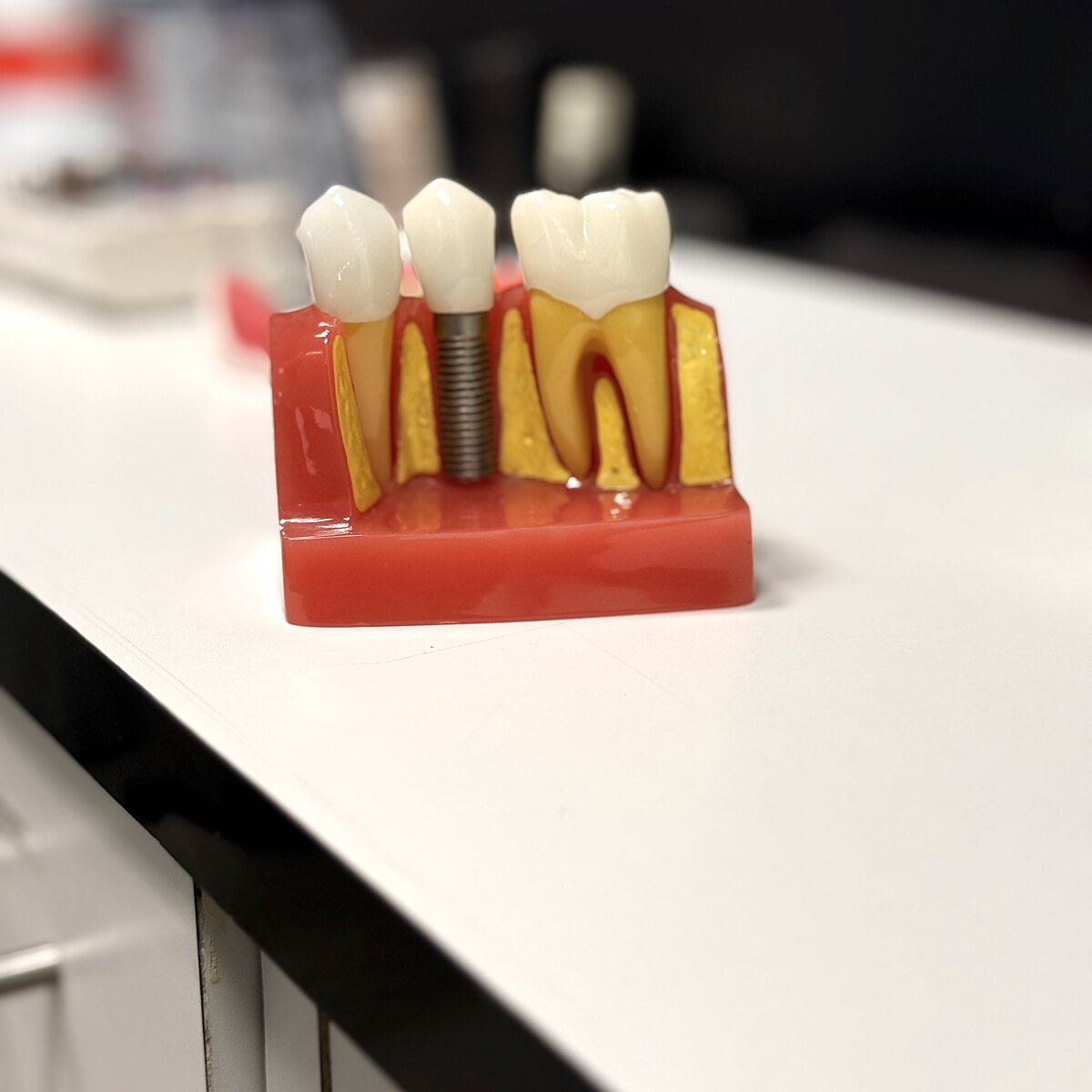 Prótesis e Implantes Dentales en Dental Spekter Cuernavaca