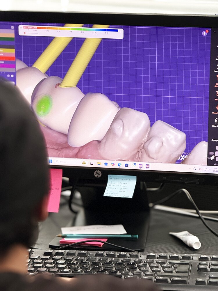 Diseño digital de sonrisa en software CAD/CAM